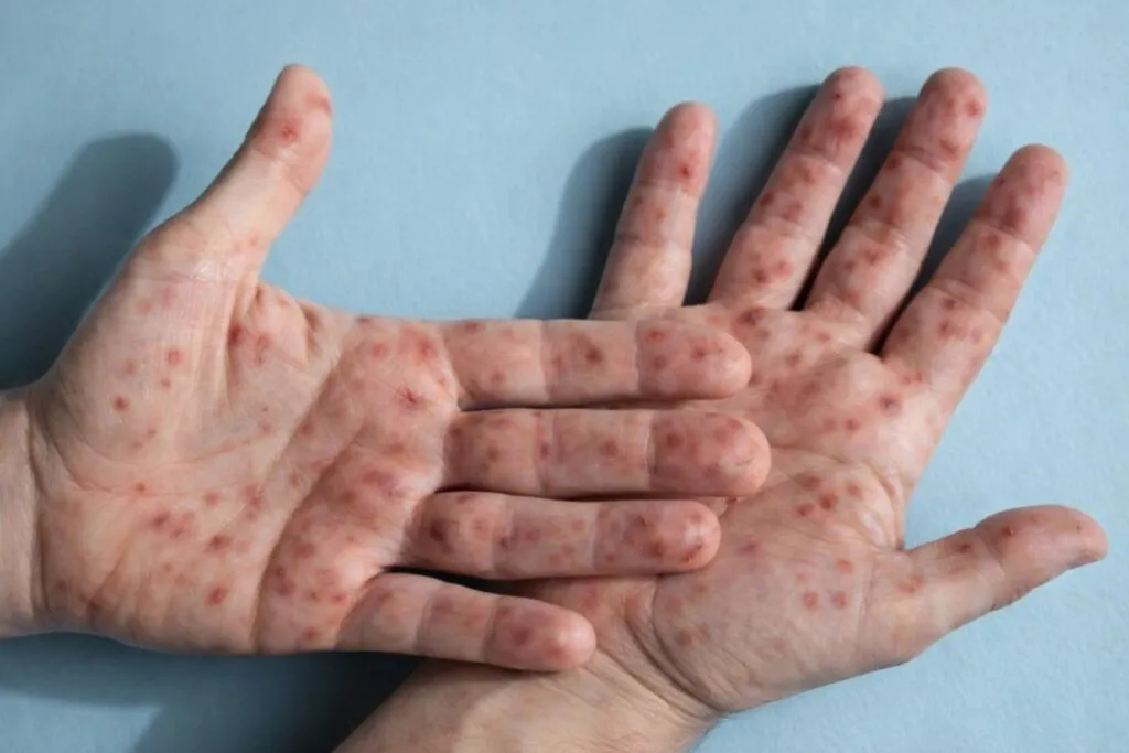 Nueva York confirma virus super contagioso ligado a viruela del mono y activa vigilancia sanitaria en marzo de 2026