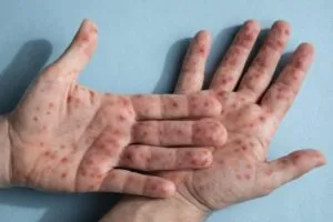 Nueva York confirma virus super contagioso ligado a viruela del mono y activa vigilancia sanitaria en marzo de 2026